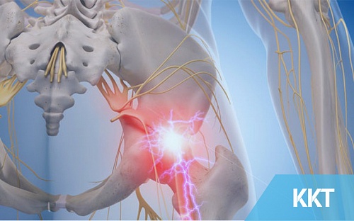 Are You Really Suffering From Sciatica??